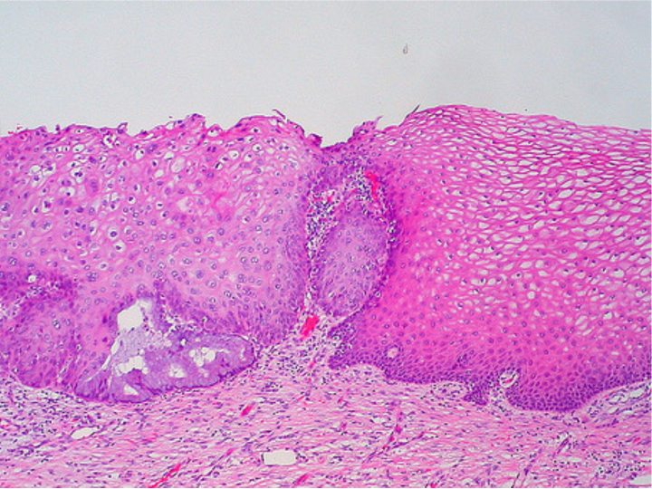 Bilden visar ett snitt från en livmoderhals. Till höger ses normal vävnad och till vänster i bilden ser man att cellerna ser annorlunda ut, är olika stora och har större cellkärnor. Kanske ett förstadium till livmoderhalscancer? I vilket fall som helst förstår ni nu vad jag menar med ”ett rosa blus”. Bild ifrån: histologyatlas.wisc.edu